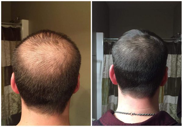 What Its Really Like To Get PRP Treatments For Male Hair Loss  The  AEDITION