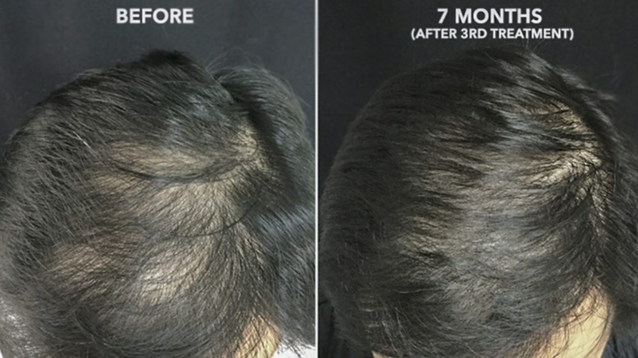 prp injections for hair loss